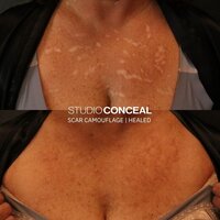 laser-burn-scar-camouflage-tattoo