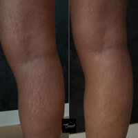 black-skin-stretch-mark-cover-up-tattoo-3