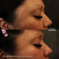 Trauma scar micropigmentation tattoo 2