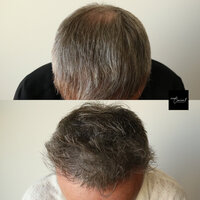 Hair-Loss-Density-Tattoo