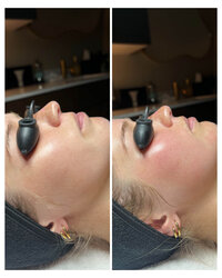 skin-and-facials-before-and-after-beau-montana-3