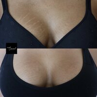 arizona-stretch-mark-removal-tattoo