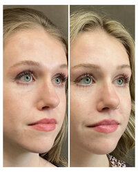 injectable-before-and-after-beau-montana
