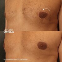 top surgery areola scar revision