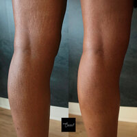 black-skin-stretch-mark-cover-up-tattoo-2