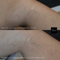 leg-lip-scar-camouflage-tattoo-3
