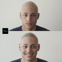 Alex-alopecia