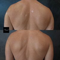 Hypopigmented-Scar-Tattoo-2