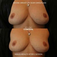 breast lift explant scar camouflage