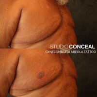 Gynecomastia AREOLA TATTOO arizona