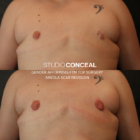 Gender-affirming-areola-tattoo-artist-top-surgery