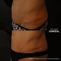 mesa stretch mark removal
