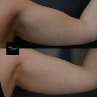 stretch-mark-arms-right-2-1
