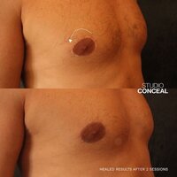 top surgery medical tattoo