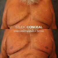 Gynecomastia 3D AREOLA TATTOO