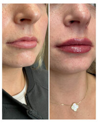 lip-filler-injectable-before-and-after-beau-montana-3