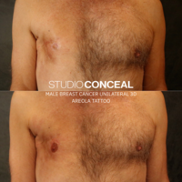 male breast cancer areola tattoo gilbert arizona