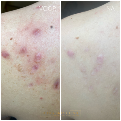 Voor en na littekens rug Ultra Skin Clinic