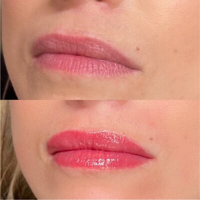 Before and after lip blush treatment at Refresh Aesthetics