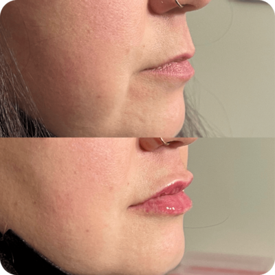 Revanesse lip filler before and after