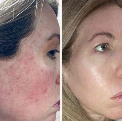 Dr. Tara O'Desky Before and After pictures of her healed skin using The Rosacea Method protocol.