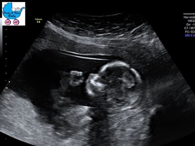 Baby's head shown in 2D Ultrasound Image