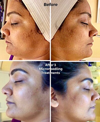 microneedling treatment results
