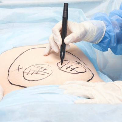 Image of woman getting incision drawings on her torso area