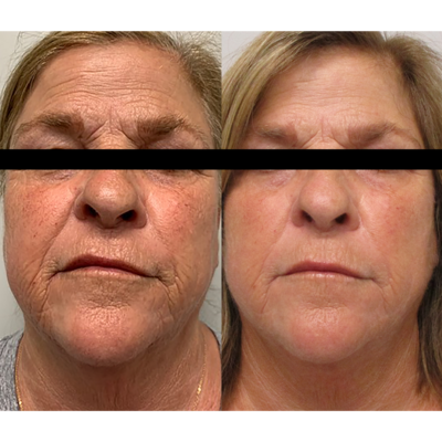 Morpheus8 Face Results