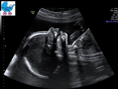 Close up of Baby's face in 3D Ultrasound Image