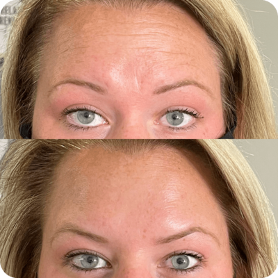Before and after a botox procedure on the forehead