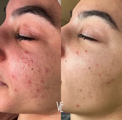 best microneedling Austin Texas