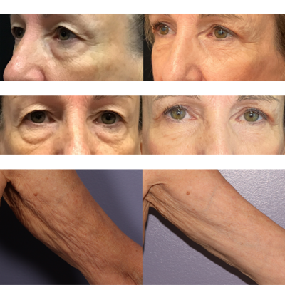 Morpheus8 Face & Arms Results