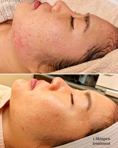 microneedling scarring treatment