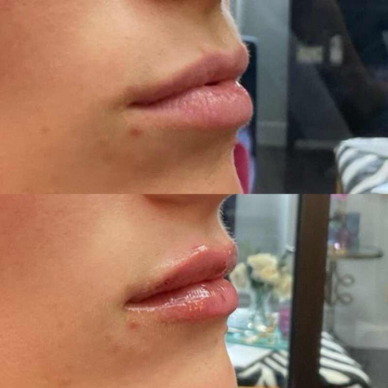 Before and after photos of Zula Modern Medspa volume loss treatment patient