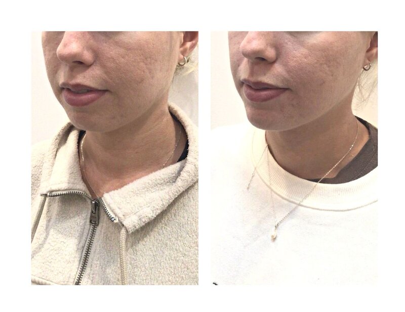 Hx: Patient presented for improvement of her ‘gummy smile’ and nasolabial folds (lines that run from nose corners to corners of mouth) which she felt had worsened since losing a significant amount of weight.