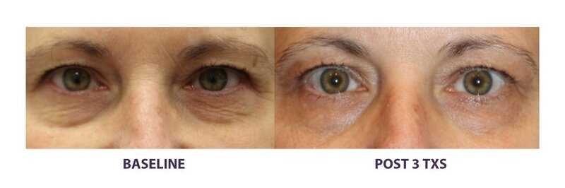 Before and after photos of Zula Modern Medspa anti-aging treatment patient