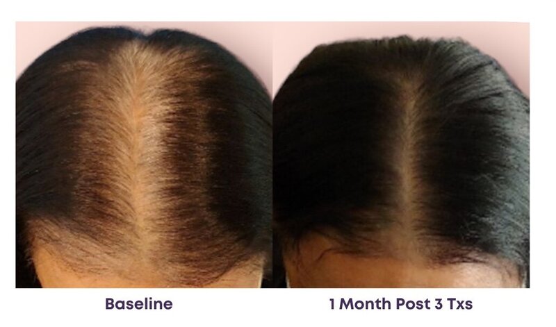 Before and after photos of Zula Modern Medspa hair thinning treatment patient