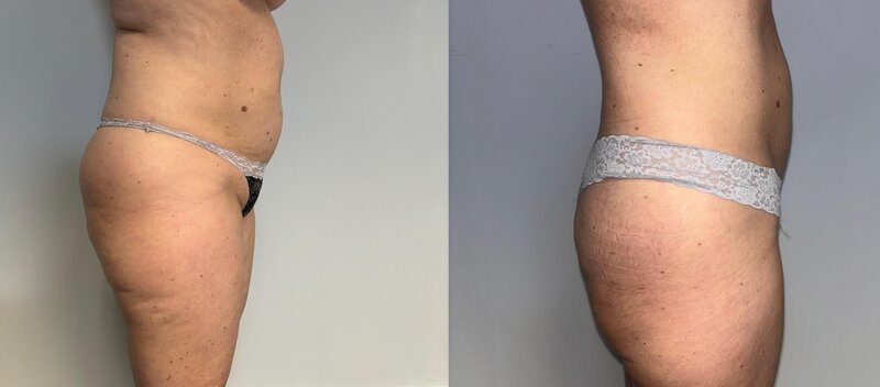Before and after photos of Zula Modern Medspa cellulite treatment patient