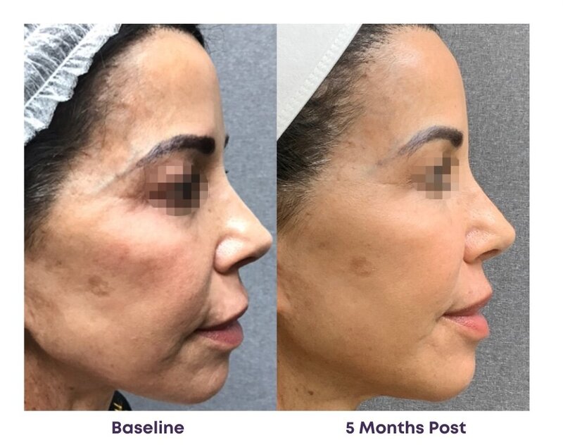 Before and after photos of Zula Modern Medspa pore texture treatment patient