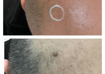 Wart-on-scalp-before-and-after-CryoPen-treatment-400x284
