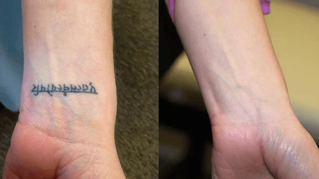 tattoo-removal-treatments2-1