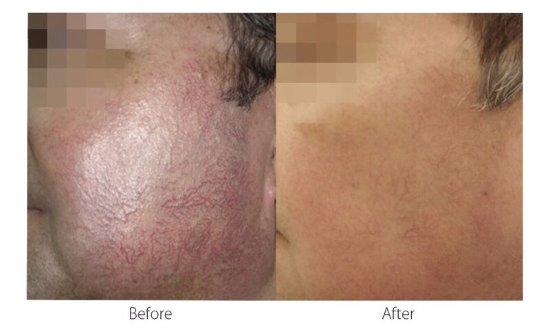 Before and after photos of Zula Modern Medspa rosacea treatment patient