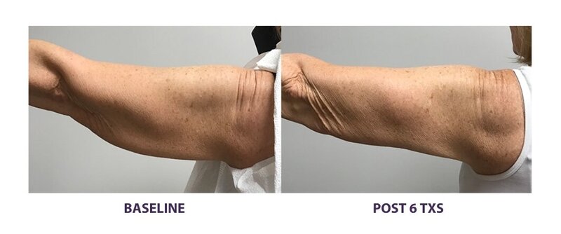 Before and after photos of Zula Modern Medspa sagging skin treatment patient