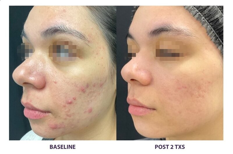 Before and after photos of Zula Modern Medspa discoloration treatment patient