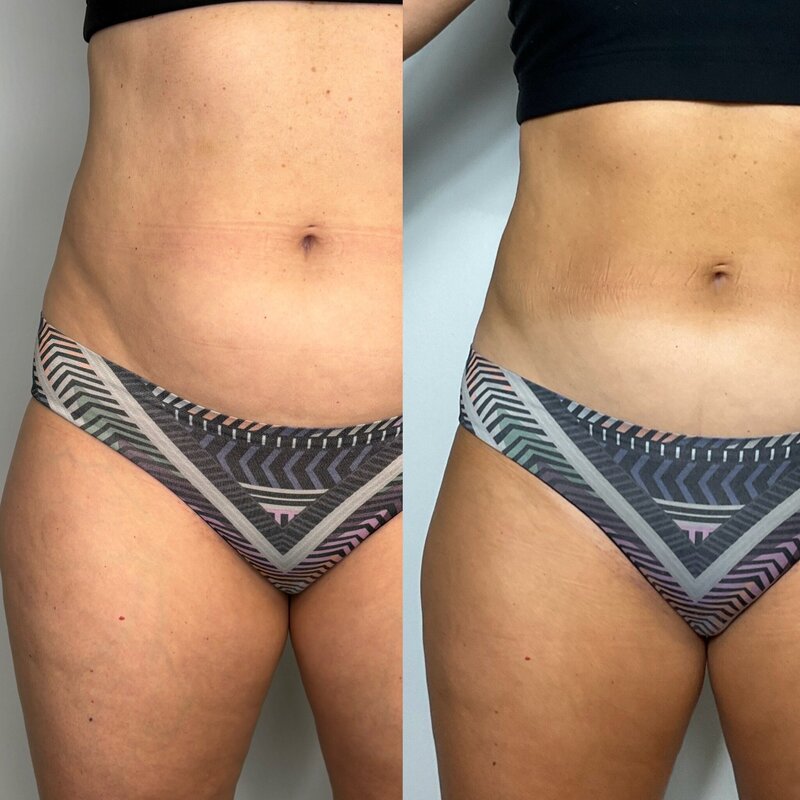 Before and after photos of Zula Modern Medspa stretch mark treatment patient