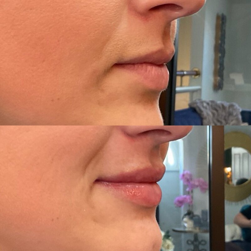 Before and after photos of Zula Modern Medspa volume loss treatment patient