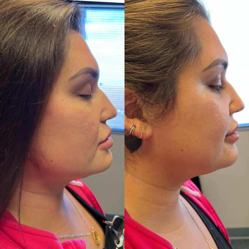 Client Results for services from Rich Medical Aesthetics in Midland, TX.