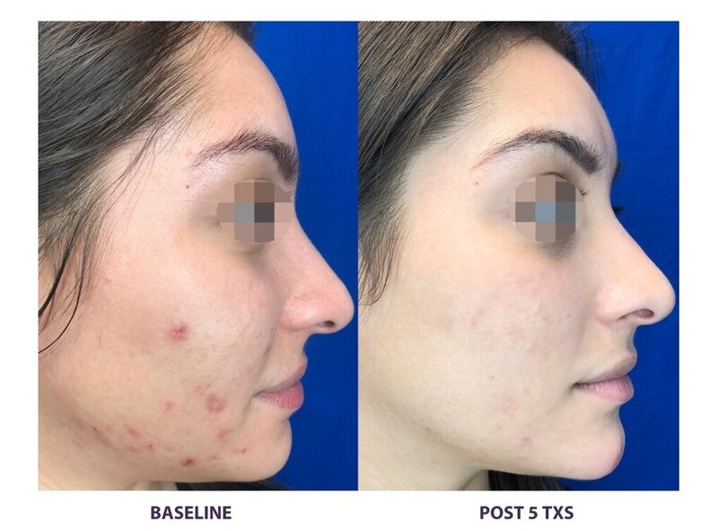 Before and after photos of Zula Modern Medspa facial treatment patient