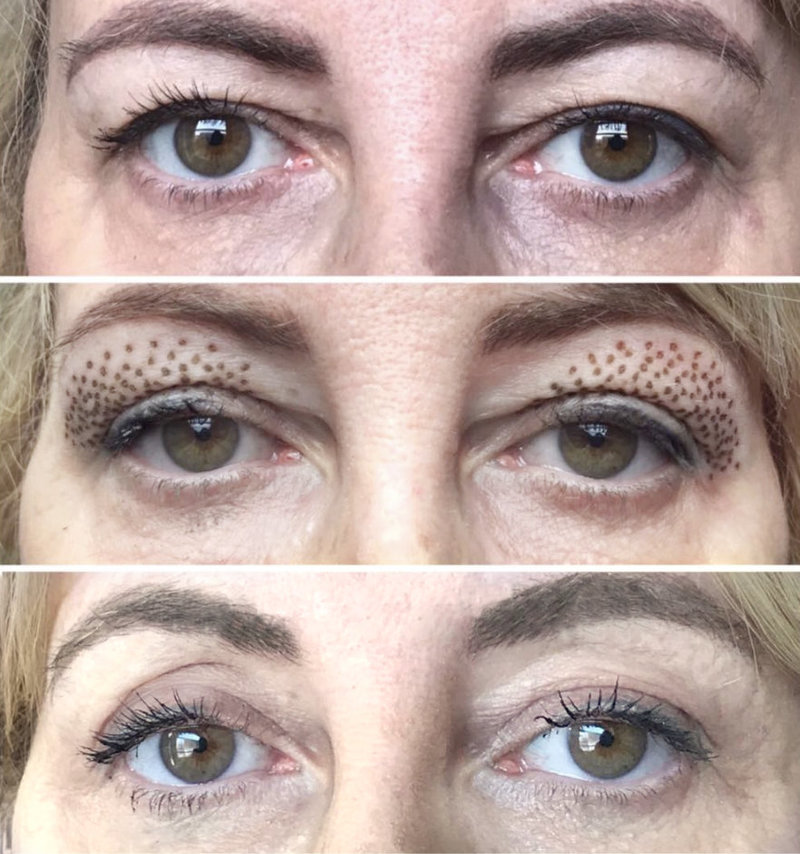eyelidlift